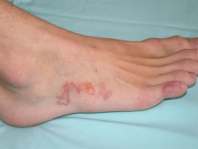 Papules -- serpiginous lesion. 